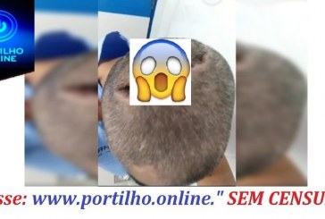 👉😱😮💉😮😭🤤😪Cenas fortes: homem é intubado com Covid e acorda com cabeça rachada