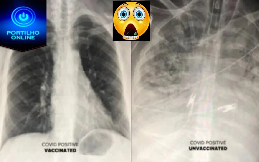 👉😮🌡💉🕯⚰😔😱Médico dos EUA mostra raio-x do efeito da covid no pulmão de vacinados