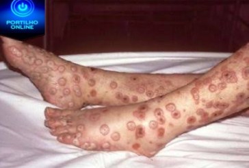 👉👀💊💉🔬🌡😱🙄🐒🐒🐒🙈Ministério da Saúde confirma terceiro caso de varíola dos macacos