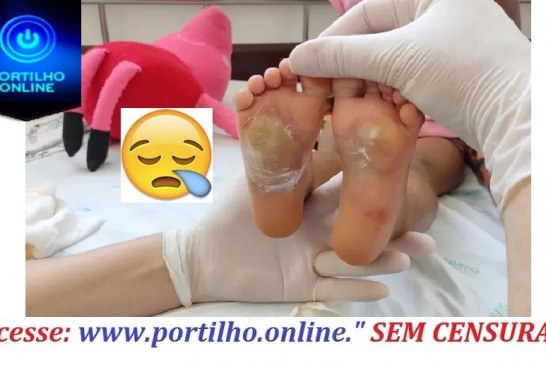 👉😪😱😪😭😔🚨🚔😳⚖🚓Polícia conclui que queimaduras em menina de 3 anos não foram causadas de maneira intencional por babá em Patos de Minas