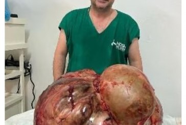 👉👀🚑🙄😳😱😮💉💊🔬Mulher tem tumor de 46 kg retirado em cirurgia de emergência no RJ