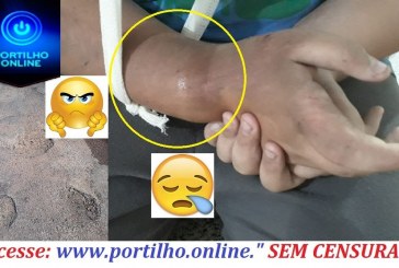 Portilho… Quebrei meu punho direito !!! E como dói…. Por causa do “buracócio-40 graus”.