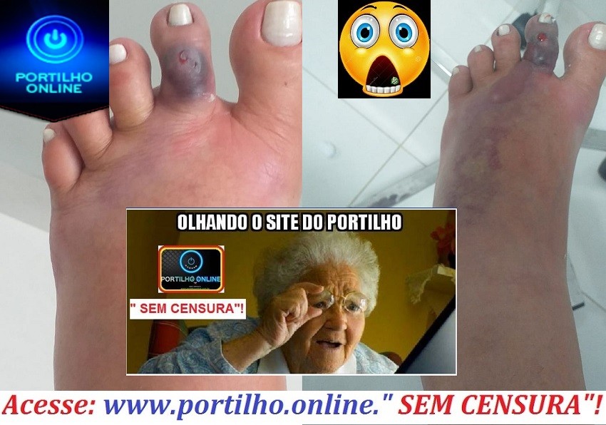 👉😮🤔😔😱🚑👉👏 👊👍👏👏👏  GANGRENA???Bom dia Portilho se eu te mandar as fotos vc chora Portilho… Ela tá tomando morfina pra dor e não resolve…