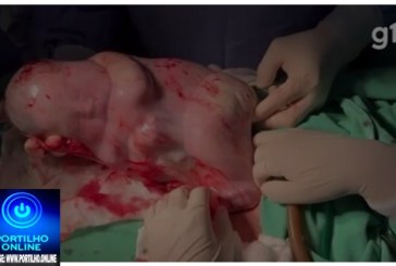 👉Assista ao vídeo…😱😳🚀😮🙏👏🙌🤲👍👏👏Bebê nasce empelicado e médico faz cócegas na barriga dele para acordá-lo; vídeo