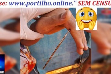 👉🤔😮🌡💉💊🔬Adolescente fura mão com agulha de crochê e é hospitalizado no DF