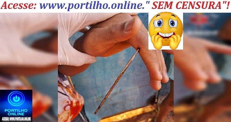 👉🤔😮🌡💉💊🔬Adolescente fura mão com agulha de crochê e é hospitalizado no DF