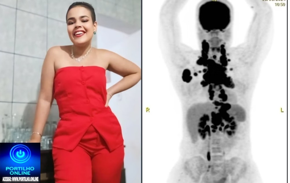 📢🧐🚑🚒✍🚨🩼🩻🩺💊Jovem conta sinais que ignorou de câncer que a “esmagava por dentro”