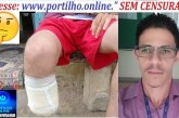 👉🧐📢😱🤔 Amputou a perna de propósito 🚔🔍🧐🔎🚑⚖🚒Servidor amputa próprio pé para receber indenização de R$ 1,5 milhão na BA