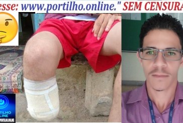 👉🧐📢😱🤔 Amputou a perna de propósito 🚔🔍🧐🔎🚑⚖🚒Servidor amputa próprio pé para receber indenização de R$ 1,5 milhão na BA