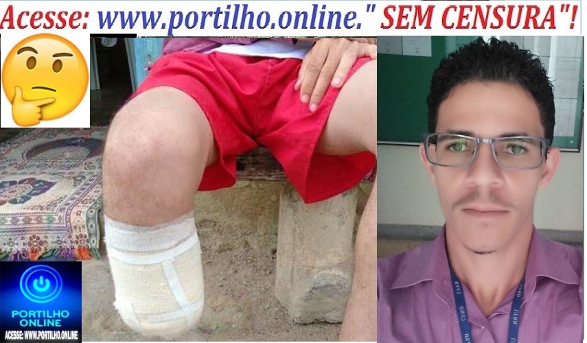 👉🧐📢😱🤔 Amputou a perna de propósito 🚔🔍🧐🔎🚑⚖🚒Servidor amputa próprio pé para receber indenização de R$ 1,5 milhão na BA