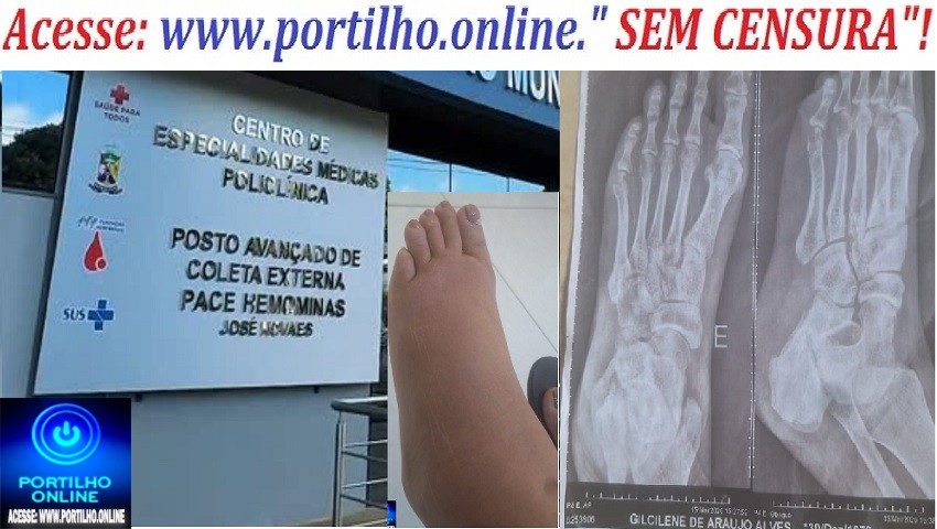 👉😡 PÉ INCHADO E BRADO😠👎🚨🚑🩺🩻🩹💊🦶😖 PACIENTE COM O PÉ QUEBRADO E INCHADO, ENFIM, SERÁ ATENDIDA NA POLICLÍNICA!