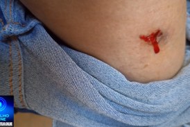 👉🏻🤔🐶 Alerta de perigo 😱😯😨🚨🗣️🚑🚒🦮🐕Meu filho foi mordido na Praça Honorato Borges